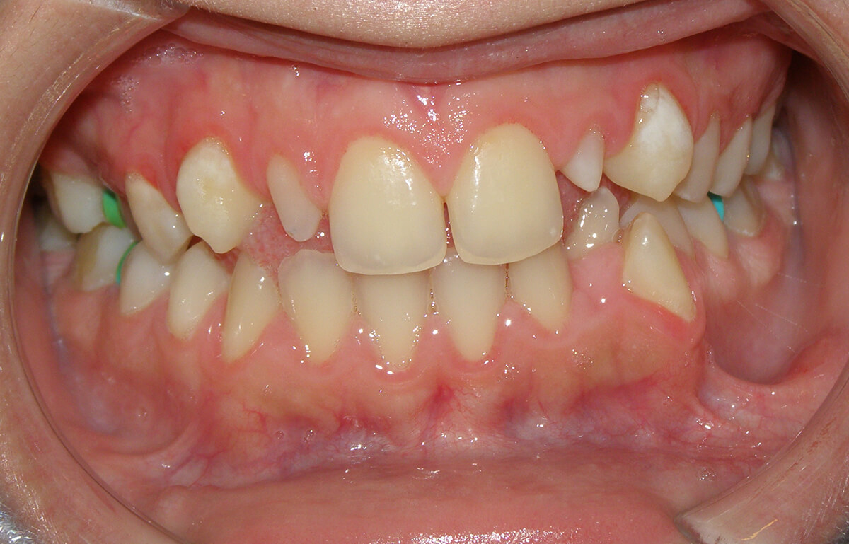 دندانهای بد شکل