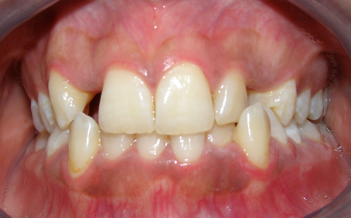 دندانهای غائب